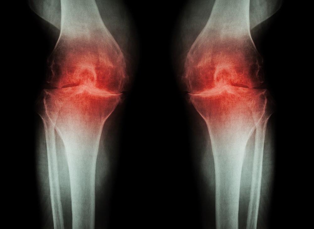 osteoarthritisknee London Bridge Orthopaedics