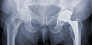 A healthy hip replacement X-ray.