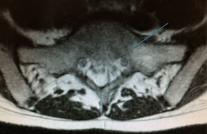 Sacral Stress Fracture