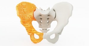 3D printed hips are set to become more common place with recent orthopaedic advances.