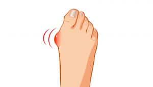 Bunions are a majour source of pain for many people.