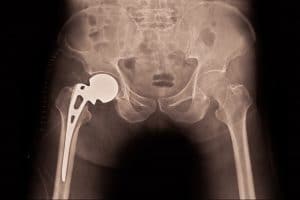 hip replacement