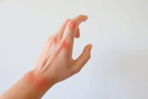 arthritis hand