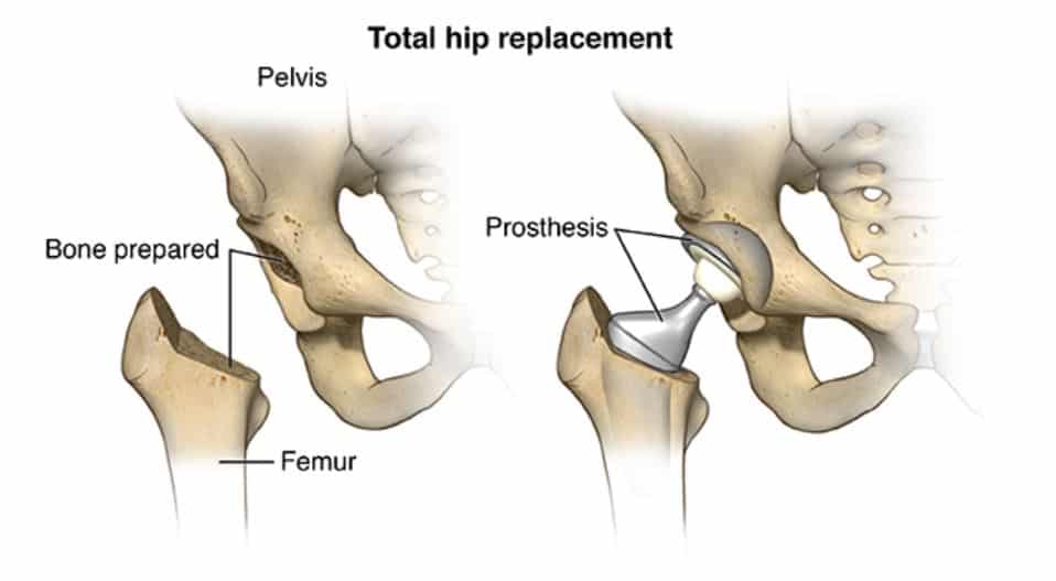 Graphic showing how a total hip replacement.