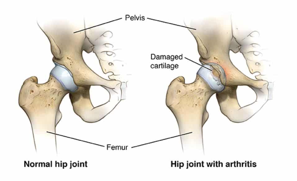 Total hip replacements showing the differences between a normal hip joint and one with arthritis. 